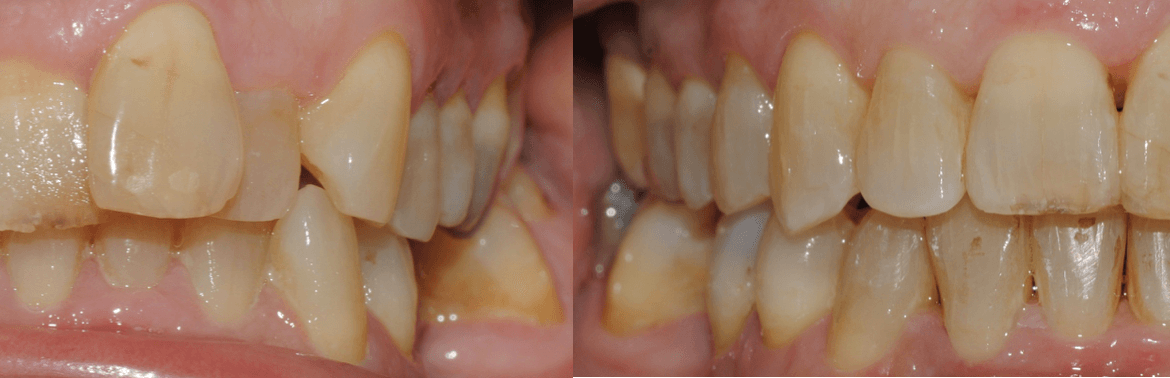 Invisalign Full – 12 meses de tratamiento