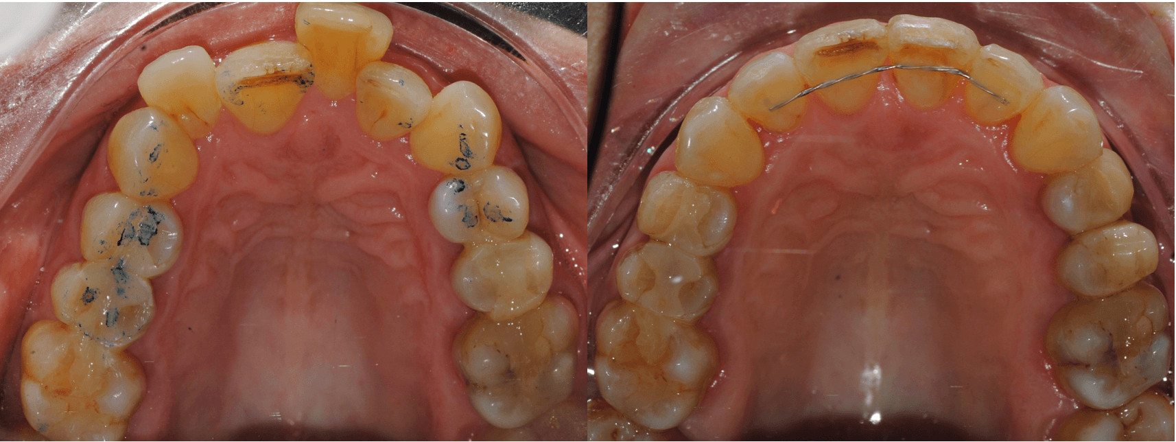 Invisalign Full 12 Meses De Tratamiento Arrels Centre Dental Invisalign Full 12 Meses De Tratamiento Arrels Centre Dental